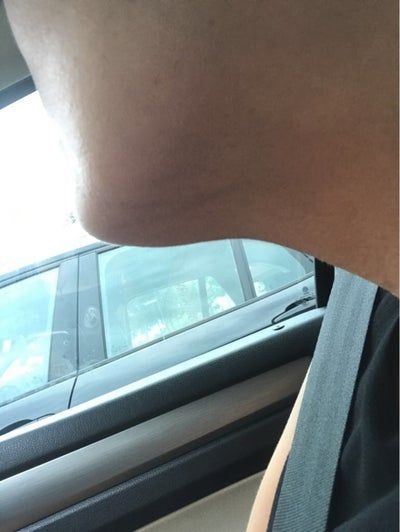 Hành trình biến hóa cổ gà tây nam tính thành cổ mảnh mai nữ tính với Kybella