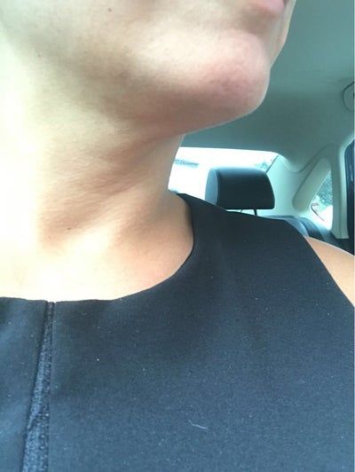 Hành trình biến hóa cổ gà tây nam tính thành cổ mảnh mai nữ tính với Kybella