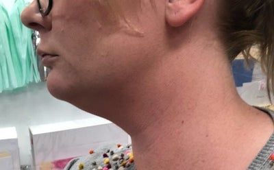 Hành trình biến hóa cổ gà tây nam tính thành cổ mảnh mai nữ tính với Kybella