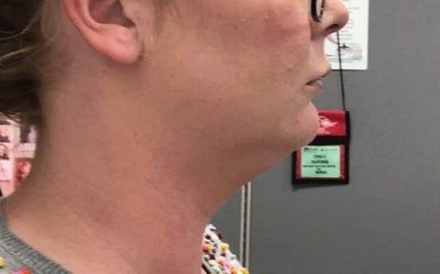 Hành trình biến hóa cổ gà tây nam tính thành cổ mảnh mai nữ tính với Kybella