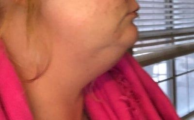 Hành trình biến hóa cổ gà tây nam tính thành cổ mảnh mai nữ tính với Kybella