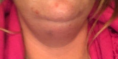 “Đó là một quá trình tiến triển chậm nhưng tôi thực sự sốc khi thấy hiệu quả nó mang lại” -  chia sẻ về kết quả tiêm Kybella của người phụ nữ 29 tuổi