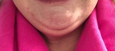 “Đó là một quá trình tiến triển chậm nhưng tôi thực sự sốc khi thấy hiệu quả nó mang lại” -  chia sẻ về kết quả tiêm Kybella của người phụ nữ 29 tuổi