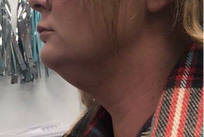 Hành trình biến hóa cổ gà tây nam tính thành cổ mảnh mai nữ tính với Kybella