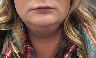 Hành trình biến hóa cổ gà tây nam tính thành cổ mảnh mai nữ tính với Kybella