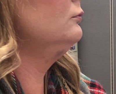 Hành trình biến hóa cổ gà tây nam tính thành cổ mảnh mai nữ tính với Kybella