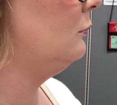 Hành trình biến hóa cổ gà tây nam tính thành cổ mảnh mai nữ tính với Kybella