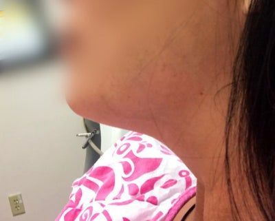Mẹ 3 con 36 tuổi với hành trình căng da bụng toàn phần, chỉnh sửa cơ, hút mỡ