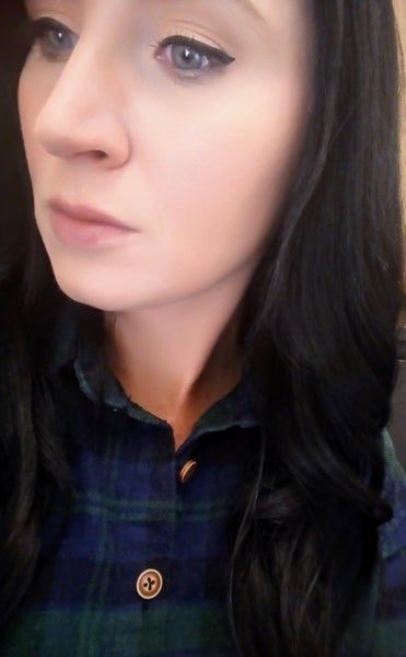 Đường viền quai hàm và khuôn mặt cô gái thay đổi rõ rệt sau khi tiêm 2 lọ Kybella