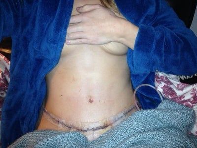 Hành trình loại bỏ khối da thừa nhăn nheo, chảy xệ sau khi giảm kỷ lục 52 kg của mẹ trẻ 2 con