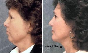 Hình ảnh căng da cổ trước sau Bác sĩ Tâm - ca 7