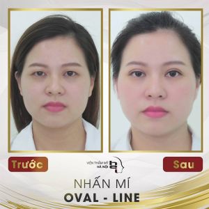 Hình ảnh nhấn mí trước sau Bs Mai Mạnh Tuấn - Ca 1