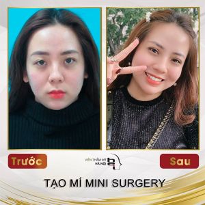 Hình ảnh cắt mí trước sau Bs Mai Mạnh Tuấn - Ca 2