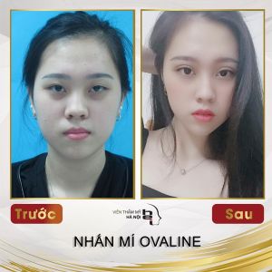 Hình ảnh nhấn mí trước sau Bs Mai Mạnh Tuấn - Ca 3
