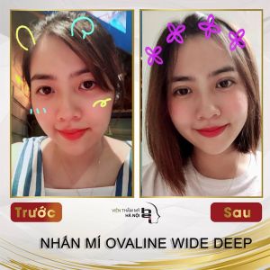 Hình ảnh nhấn mí trước sau Bs Mai Mạnh Tuấn - Ca 4