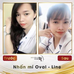 Hình ảnh nhấn mí trước sau Bs Mai Mạnh Tuấn - Ca 5