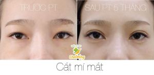 Hình ảnh cắt mí trước sau 5 tháng Bs Nguyễn Khanh - Ca 1