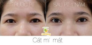 Hình ảnh cắt mí trước sau 1 năm Bs Nguyễn Khanh - Ca 2