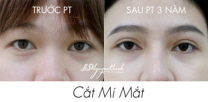 Hình ảnh cắt mí trước và sau 3 năm Bs Nguyễn Khanh - Ca 3
