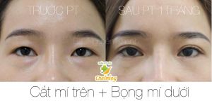 Hình ảnh cắt mí trước và sau 1 tháng Bs Nguyễn Khanh - Ca 4