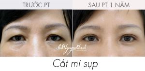 Hình ảnh cắt mí trước và sau Bs Nguyễn Khanh - Ca 5