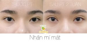 Hình ảnh nhấn mí trước và sau 2 tuần Bs Nguyễn Khanh - Ca 7