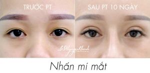 Hình ảnh nhấn mí trước và sau 10 ngày Bs Nguyễn Khanh - Ca 9