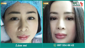 Hình ảnh cắt mí trước sau Bs Tống Hải - Ca 1