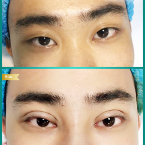 Hình ảnh cắt mí trước sau Bs Tống Hải - Ca 2