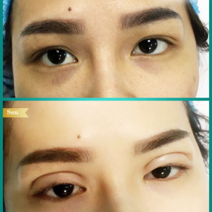 Hình ảnh nhấn mí trước sau Bs Tống Hải - Ca 3