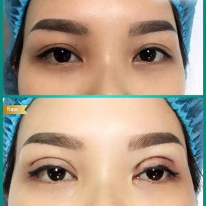 Hình ảnh cắt mí trước sau Bs Tống Hải - Ca 4