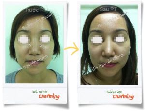 Hình ảnh cắt xương làm thẳng mũi bs Nguyễn Khanh - Ca 1