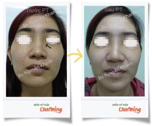 Hình ảnh cắt xương làm thẳng mũi bs Nguyễn Khanh - Ca 2