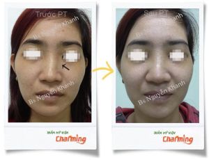 Hình ảnh cắt xương làm thẳng mũi bs Nguyễn Khanh - Ca 2