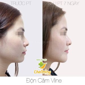 Hình ảnh độn cằm trước sau Bs Nguyễn Khanh - Ca 1