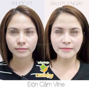 Hình ảnh độn cằm trước sau Bs Nguyễn Khanh - Ca 1