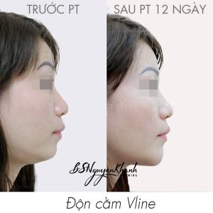 Hình ảnh độn cằm trước sau Bs Nguyễn Khanh - Ca 10