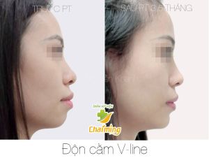 Hình ảnh độn cằm trước sau Bs Nguyễn Khanh - Ca 15