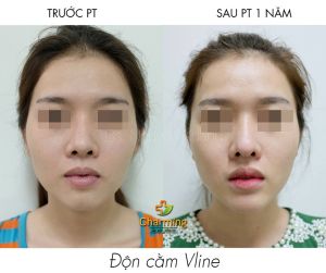 Hình ảnh độn cằm trước sau Bs Nguyễn Khanh - Ca 19