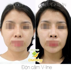 Hình ảnh độn cằm trước sau Bs Nguyễn Khanh - Ca 2