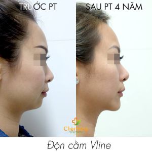 Hình ảnh độn cằm trước sau Bs Nguyễn Khanh - Ca 22