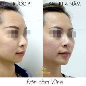 Hình ảnh độn cằm trước sau Bs Nguyễn Khanh - Ca 22