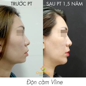 Hình ảnh độn cằm trước sau Bs Nguyễn Khanh - Ca 27