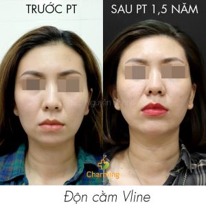 Hình ảnh độn cằm trước sau Bs Nguyễn Khanh - Ca 27