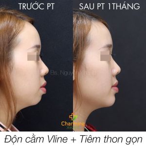 Hình ảnh độn cằm trước sau Bs Nguyễn Khanh - Ca 30