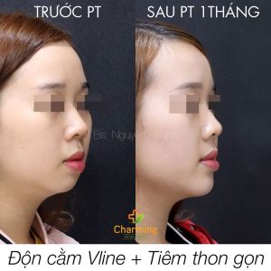 Hình ảnh độn cằm trước sau Bs Nguyễn Khanh - Ca 30