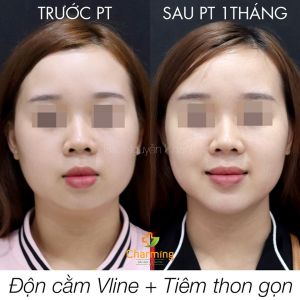 Hình ảnh độn cằm trước sau Bs Nguyễn Khanh - Ca 30