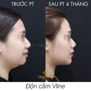 Hình ảnh độn cằm trước sau Bs Nguyễn Khanh - Ca 31