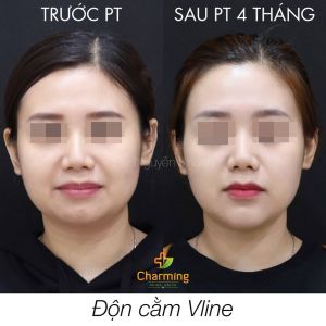 Hình ảnh độn cằm trước sau Bs Nguyễn Khanh - Ca 31