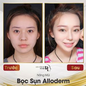 Hình ảnh nâng mũi trước sau Bs Mai Mạnh Tuấn – Ca 1